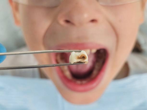 Best Emergency Root Canal Treatment in Sumner, WA